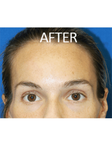 Mole Removal Before and After Pictures West Palm Beach, FL