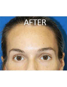 Mardirossian Facial Aesthetics Before and After Pictures