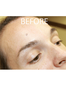 Mole Removal Before and After Pictures West Palm Beach, FL