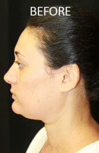 ThermiTight® & Neck Lipo Before and After Pictures West Palm Beach, FL