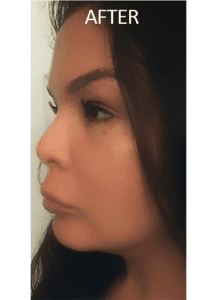 Mardirossian Facial Aesthetics Before and After Pictures