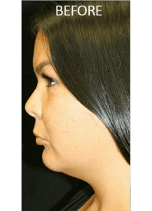 ThermiTight® & Neck Lipo Before and After Pictures West Palm Beach, FL