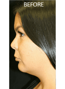 Mardirossian Facial Aesthetics Before and After Pictures