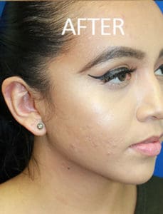 Otoplasty Before and After Pictures West Palm Beach, FL