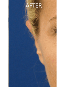 Otoplasty Before and After Pictures West Palm Beach, FL