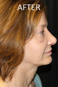 Rhinoplasty Before and After Pictures West Palm Beach, FL