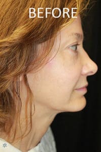 Rhinoplasty Before and After Pictures West Palm Beach, FL