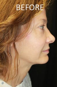 Mardirossian Facial Aesthetics Before and After Pictures