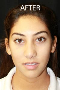 Rhinoplasty Before and After Pictures West Palm Beach, FL
