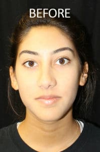 Rhinoplasty Before and After Pictures West Palm Beach, FL