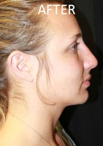 Rhinoplasty Before and After Pictures West Palm Beach, FL