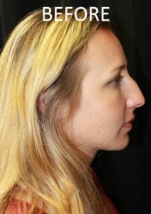 Rhinoplasty Before and After Pictures West Palm Beach, FL