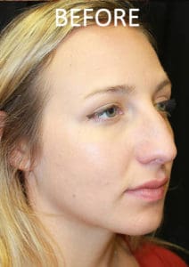 Rhinoplasty Before and After Pictures West Palm Beach, FL