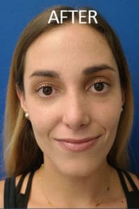 Rhinoplasty Before and After Pictures West Palm Beach, FL