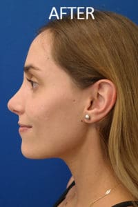 Rhinoplasty Before and After Pictures West Palm Beach, FL