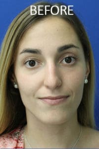 Rhinoplasty Before and After Pictures West Palm Beach, FL