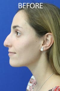 Rhinoplasty Before and After Pictures West Palm Beach, FL