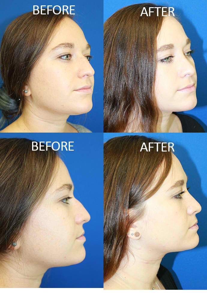 Rhinoplasty