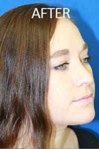 Rhinoplasty Before and After Pictures West Palm Beach, FL