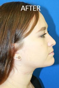 Rhinoplasty Before and After Pictures West Palm Beach, FL