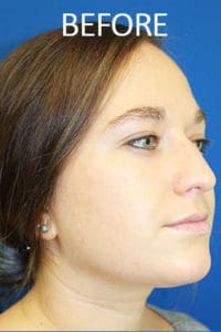 Rhinoplasty Before and After Pictures West Palm Beach, FL
