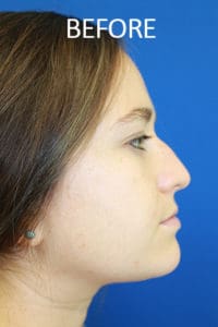 Rhinoplasty Before and After Pictures West Palm Beach, FL
