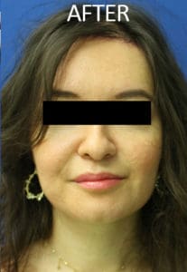 Scalp Advancement Before and After Pictures West Palm Beach, FL