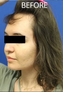 Scalp Advancement Before and After Pictures West Palm Beach, FL