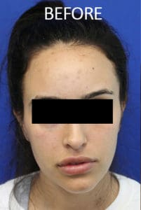 Scalp Advancement Before and After Pictures West Palm Beach, FL