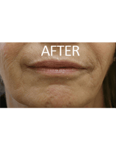 Smile Lift Before and After Pictures West Palm Beach, FL