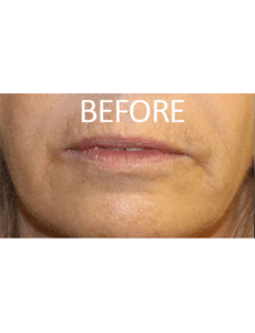 Smile Lift Before and After Pictures West Palm Beach, FL