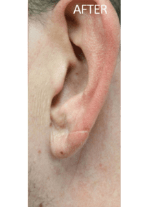 Earlobes repair Philadelphia, PA Torn Ear Lobe Main Line