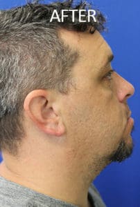 Torn Earlobe Repair Before and After Pictures West Palm Beach, FL