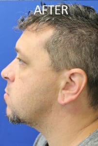 Torn Earlobe Repair Before and After Pictures West Palm Beach, FL