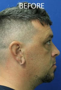 Mardirossian Facial Aesthetics Before and After Pictures