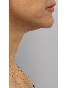 Neck Lift Before and After Pictures West Palm Beach, FL
