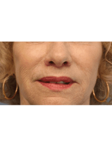 Lip Implants Before and After Pictures West Palm Beach, FL
