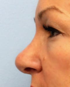 Rhinoplasty Before and After Pictures West Palm Beach, FL
