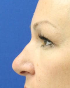 Rhinoplasty Before and After Pictures West Palm Beach, FL