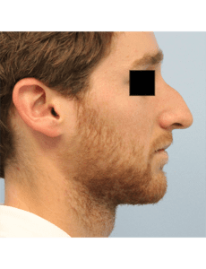 Rhinoplasty Before and After Pictures West Palm Beach, FL