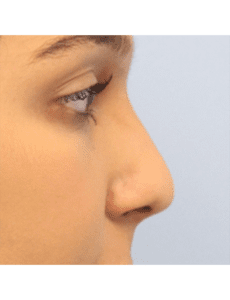 Rhinoplasty Before and After Pictures West Palm Beach, FL