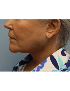 Neck Lift Before and After Pictures West Palm Beach, FL