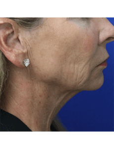 Facelift and Neck Lift Before and After Pictures West Palm Beach, FL