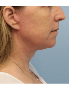 Facelift and Neck Lift Before and After Pictures West Palm Beach, FL