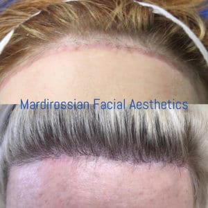 Facial Feminization Surgery (FFS) Before and After Pictures West Palm Beach, FL