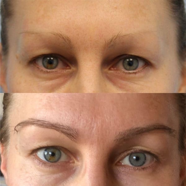Hair Transplant Before and After Pictures West Palm Beach, FL