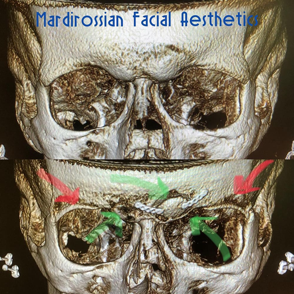Forehead Contouring McLean, VA | McLean, VA Forehead Contouring