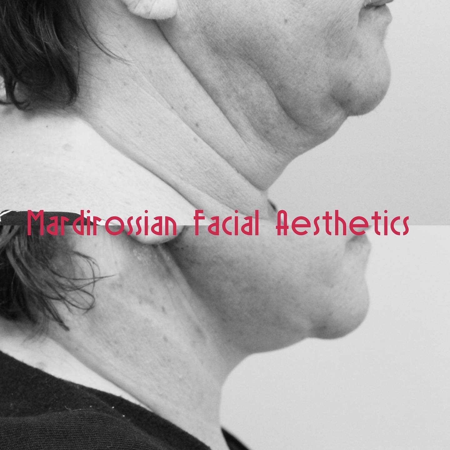 Facelift and Neck lift Before and After Pictures McLean, VA