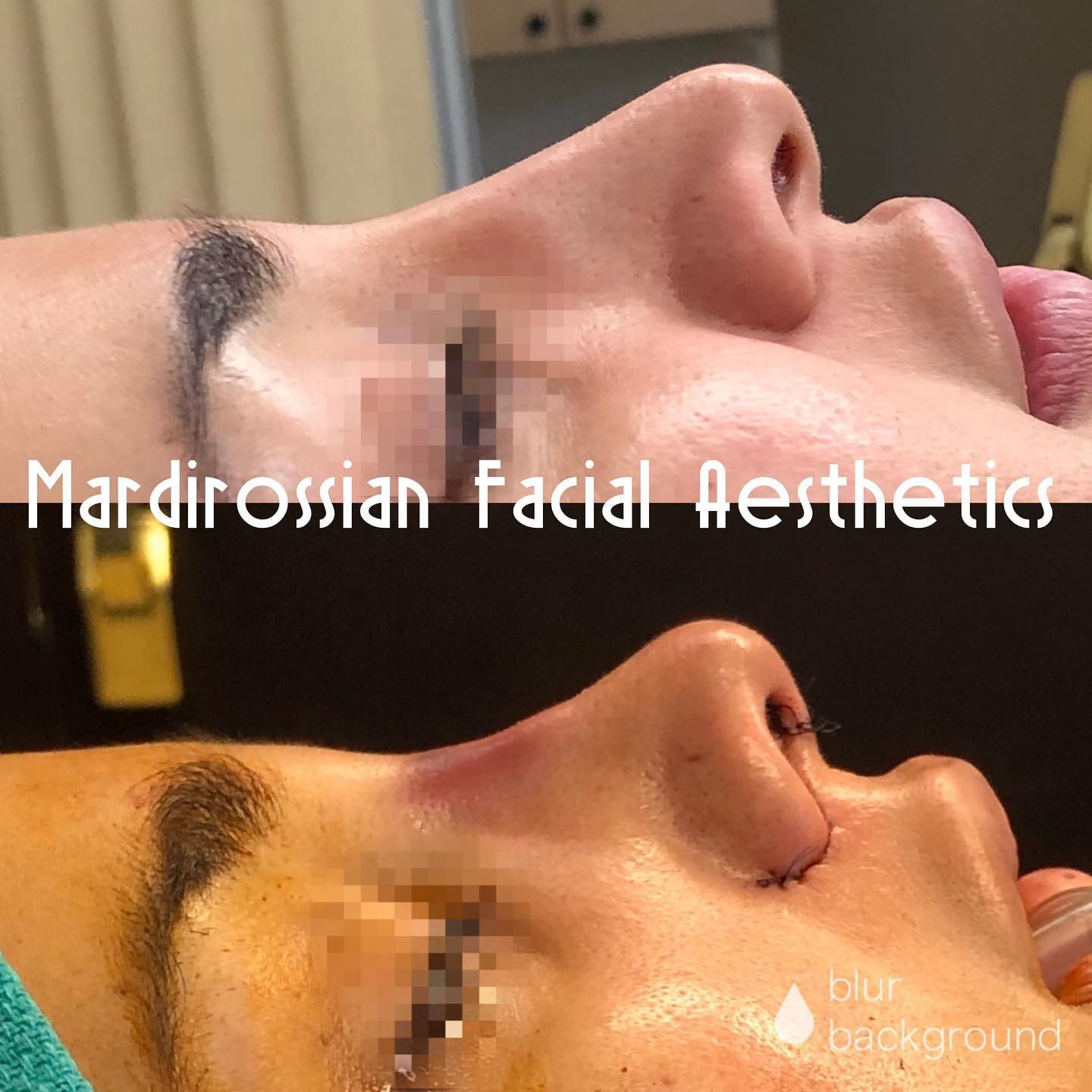 Rhinoplasty Before and After Pictures McLean, VA