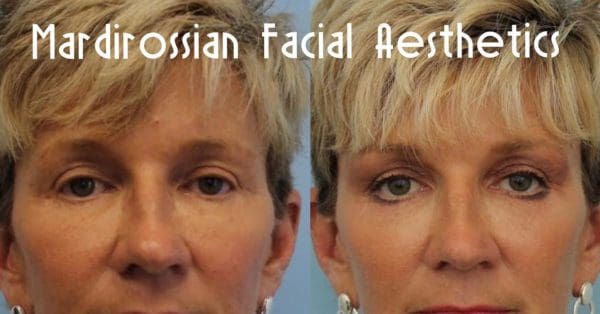 Midface Lift Before and After Pictures West Palm Beach, FL